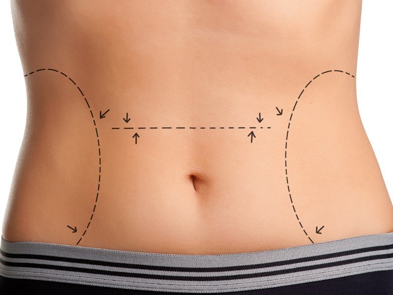 Tummy tuck: types of correction