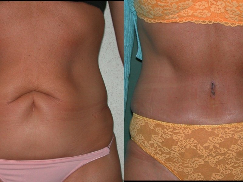 Tummy tuck: reversible abdominal surgery