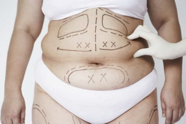 Abdominal tummy tuck