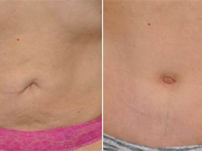 Before and after photo umbilicoplasty