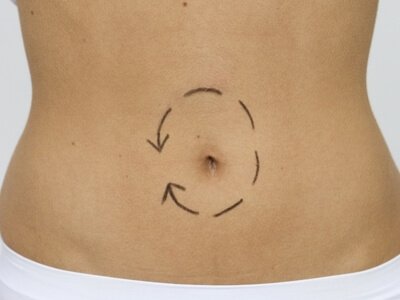 Plastic navel surgery