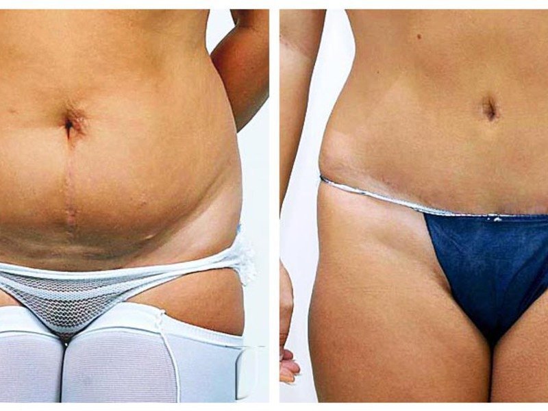 Tummy tuck after childbirth: before and after