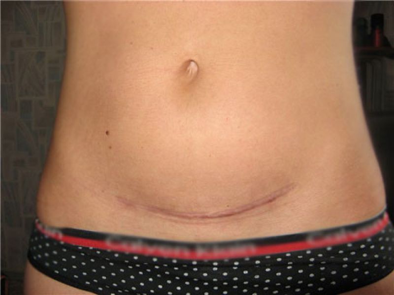 Cesarean scar