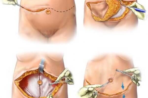 Abdominoplasty