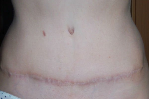 Ugly scar after abdominoplasty