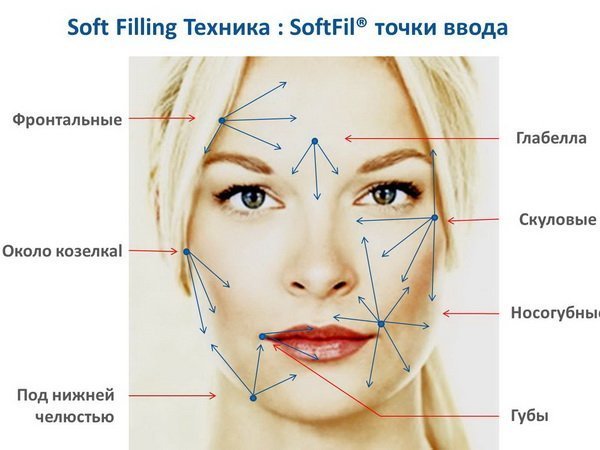 Places and directions for the introduction of fillers for face contouring