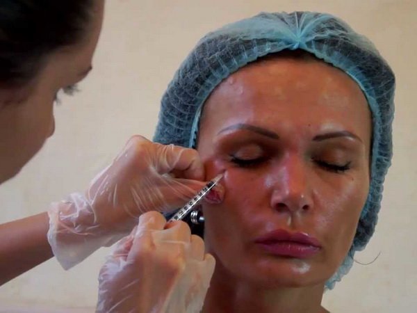 The procedure for contouring the eyelids