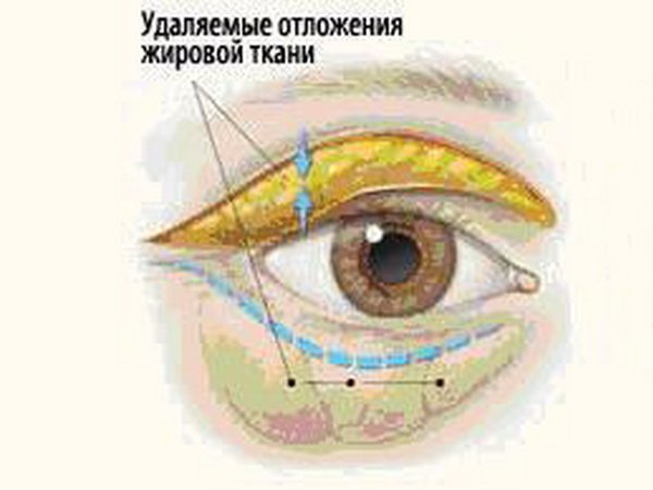 Removable adipose tissue in blepharoplasty
