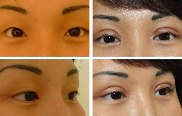 Oriental Blepharoplasty