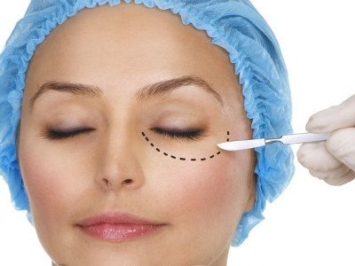 Is it possible to repeat blepharoplasty?