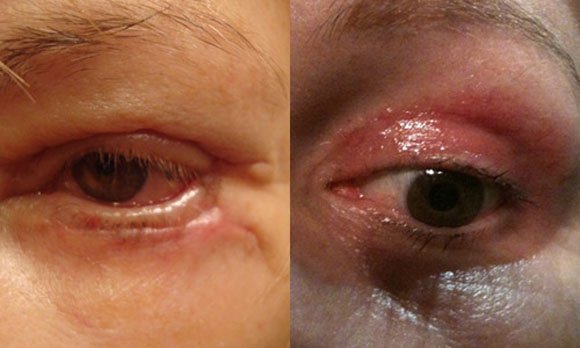 The consequences of unsuccessful rehabilitation after blepharoplasty