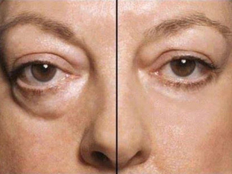 How to care for bags under the eyes after blepharoplasty