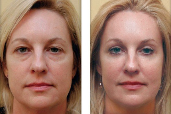 Blepharoplasty lower eyelids