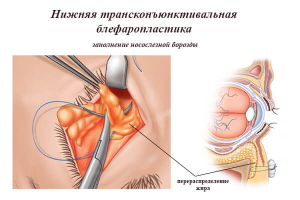 Transconjunctival lower eyelid blepharoplasty