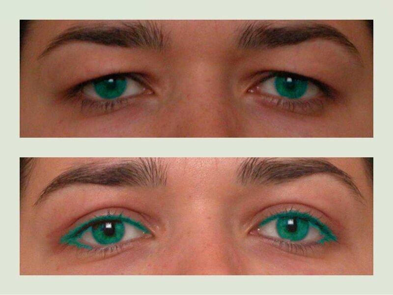 blepharoplasty upper eyelids