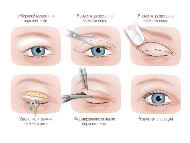 plastic upper eyelids