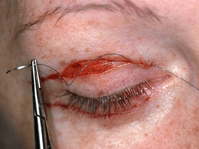 upper eyelid lift