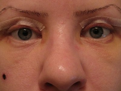 upper eyelid correction