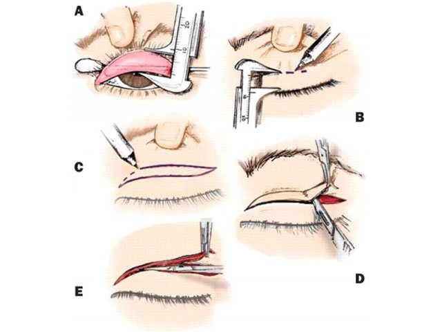 Asian eyelid surgery with incision