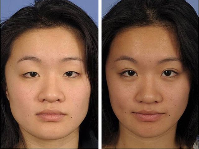 The results of epikantoplastiki - plastics of the eastern eyelids