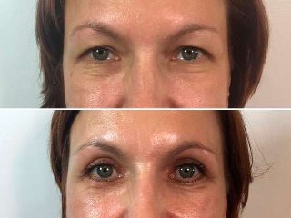 Before and after upper blepharoplasty