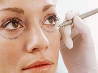 Preparing for upper blepharoplasty