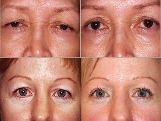 Blepharoplasty results