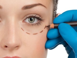 Lower blepharoplasty