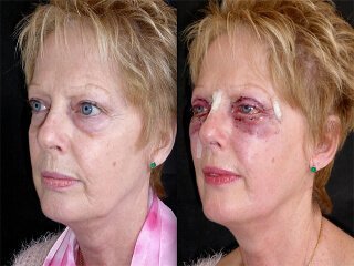 Complications after lower blepharoplasty