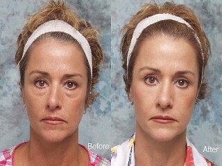 Before and after lower eyelid blepharoplasty