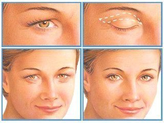 Eyelid correction