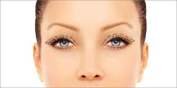 Blepharoplasty eyes