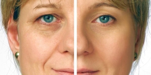 Rejuvenation of the eyelids