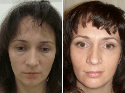 Result plastic eyelids laser