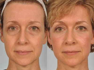 Laser eyelid lift