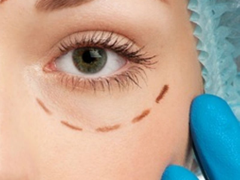 At the doctor's appointment for the correction of the lower eyelids