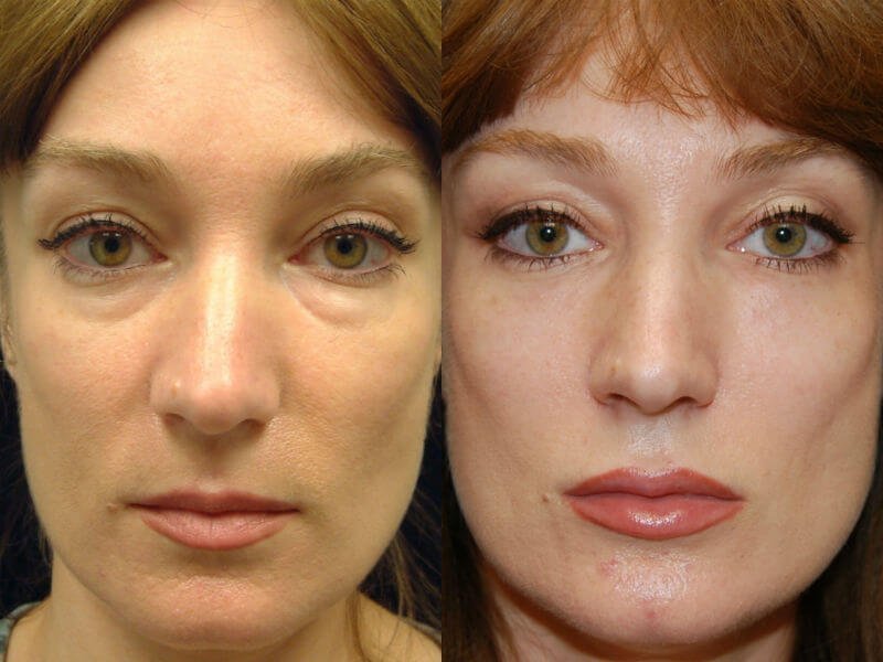 Laser polishing of the eyelids after blepharoplasty