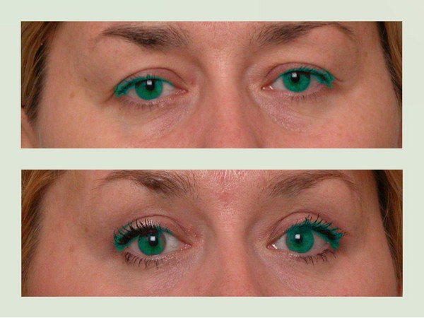 What are the swelling of the eyelids after blepharoplasty