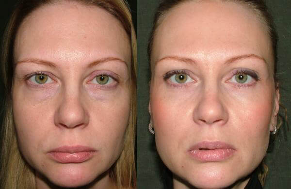 Blepharoplasty lower eyelids