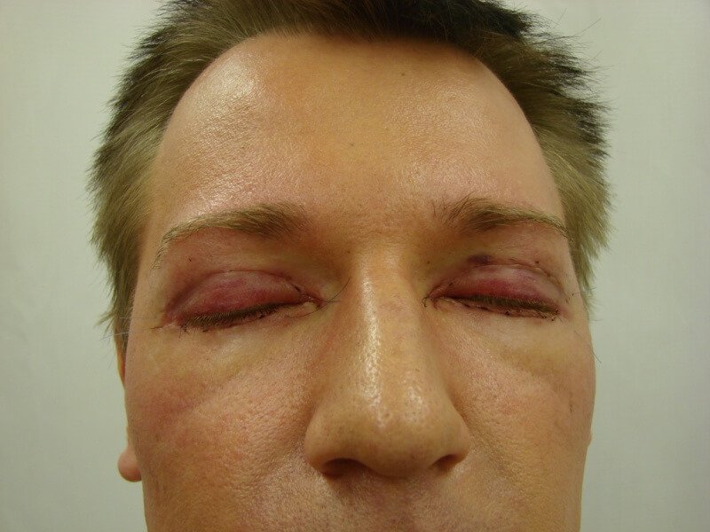 Scars after blepharoplasty