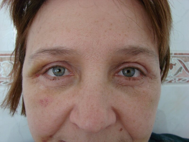 Bruises after blepharoplasty