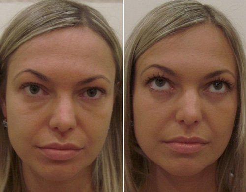 Injection treatment for scars after blepharoplasty