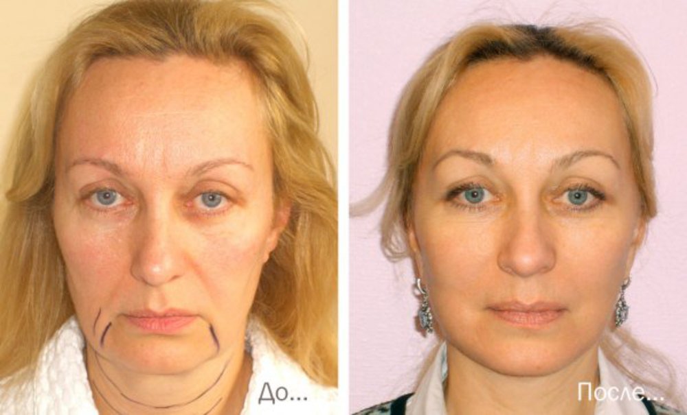 Results of a circular facelift