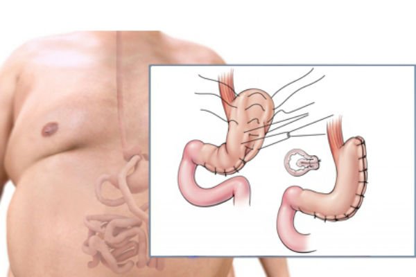 Stomach resection for weight loss