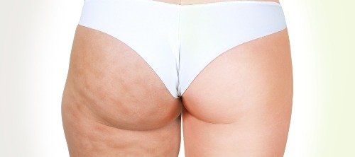 Cellulite Removal