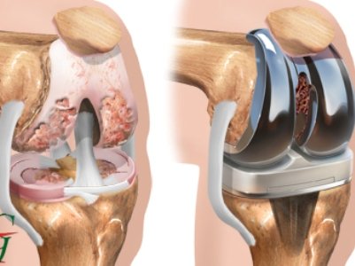 Prosthetic knee photo