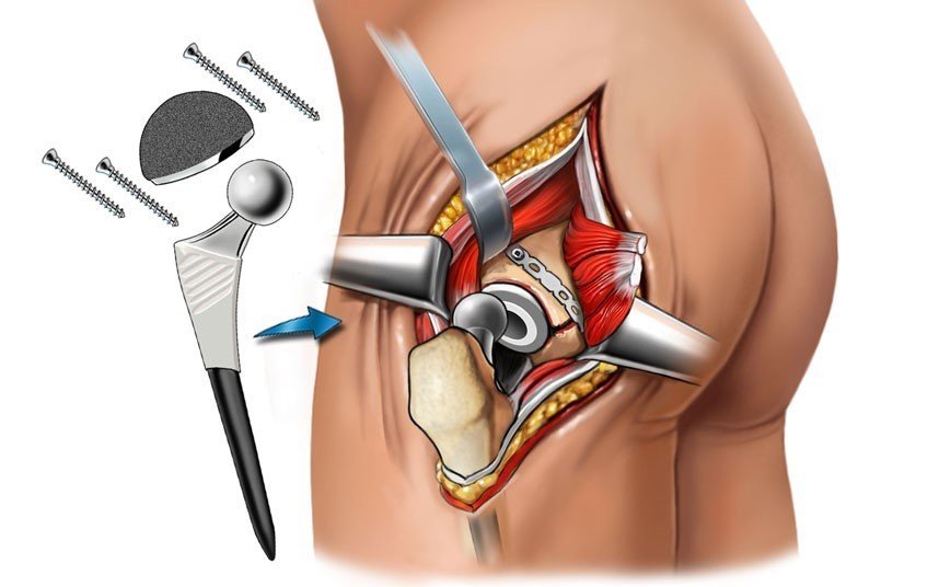 Hip arthroplasty