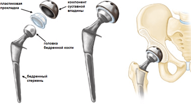 Hip arthroplasty