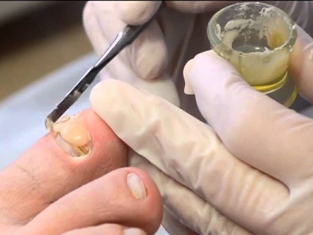 Prosthetics of toenails