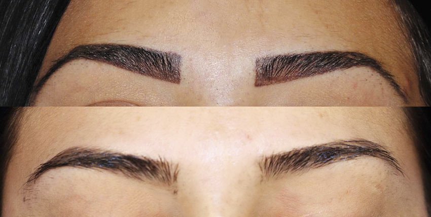 Eyebrow correction